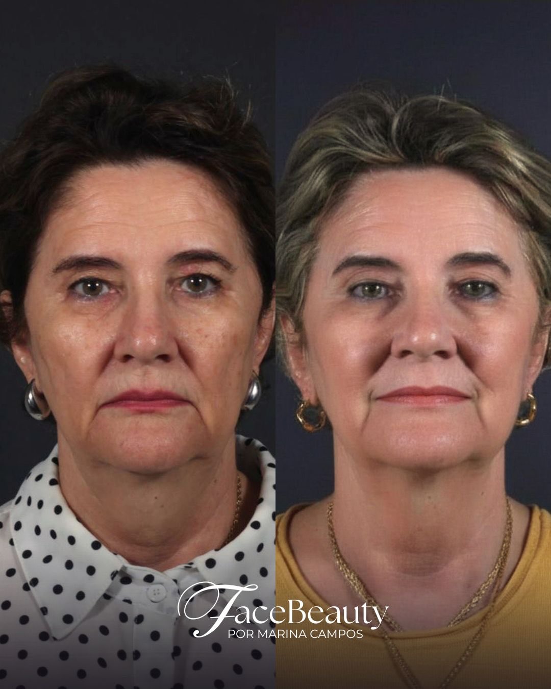 Antes e depois — Lifting e firmeza da pele