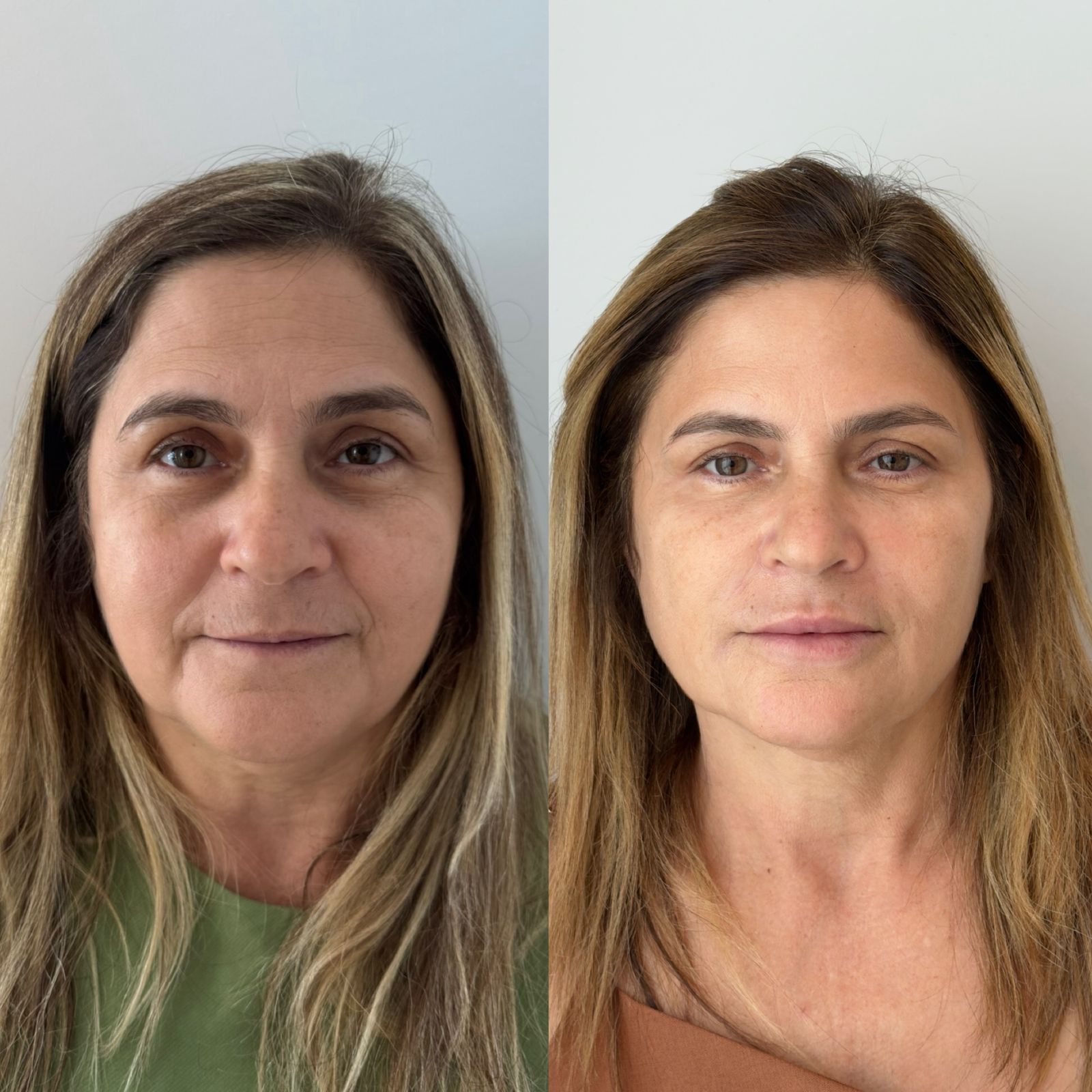 Antes e depois — Rejuvenescimento facial