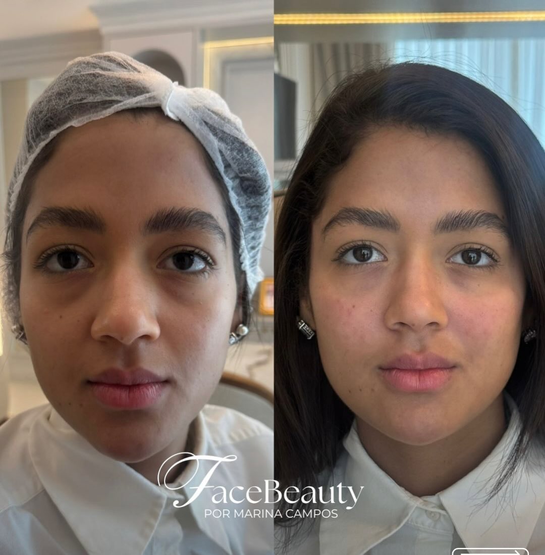 Antes e depois — Olheiras e harmonização do olhar