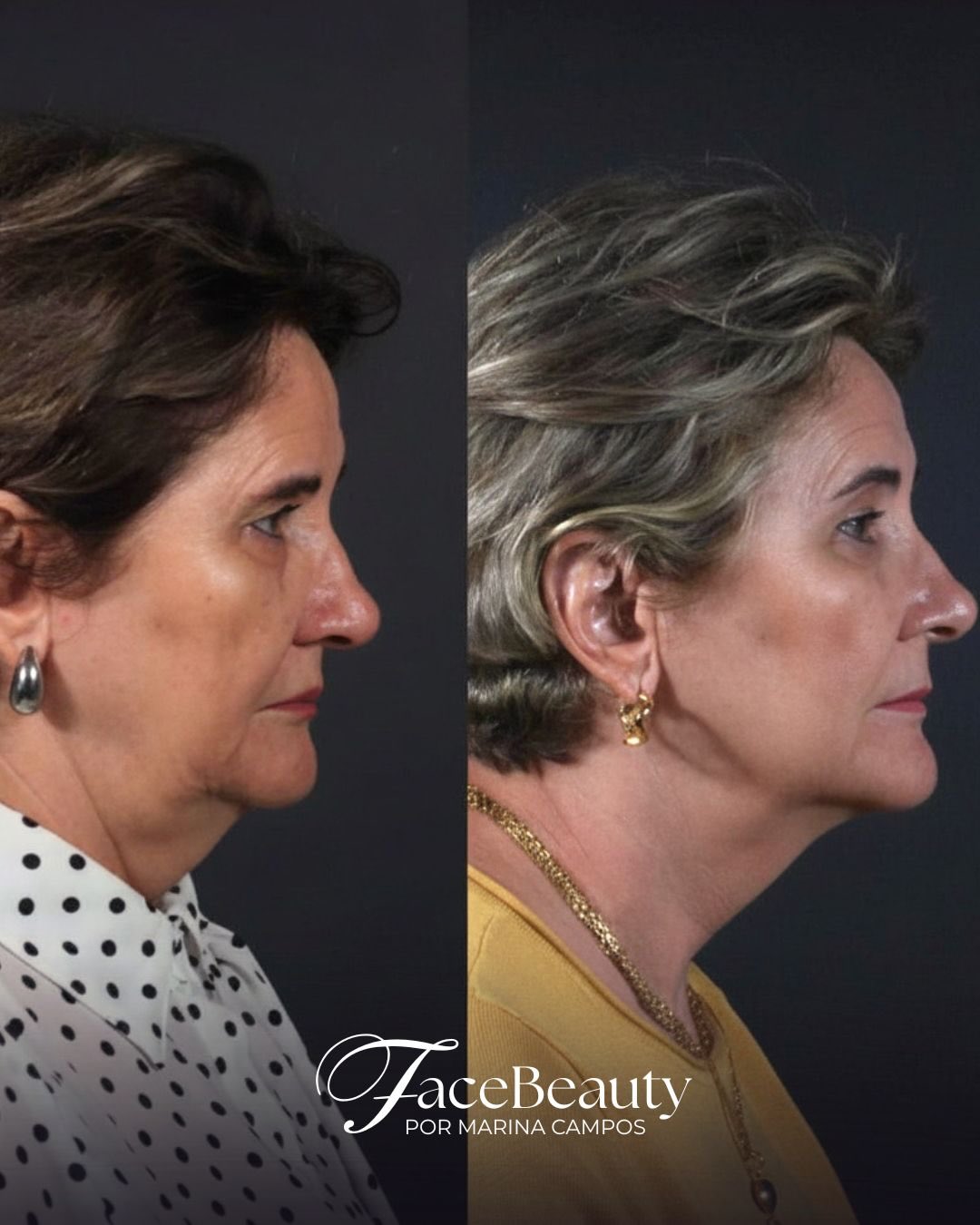 Antes e depois — Rejuvenescimento e definição do perfil