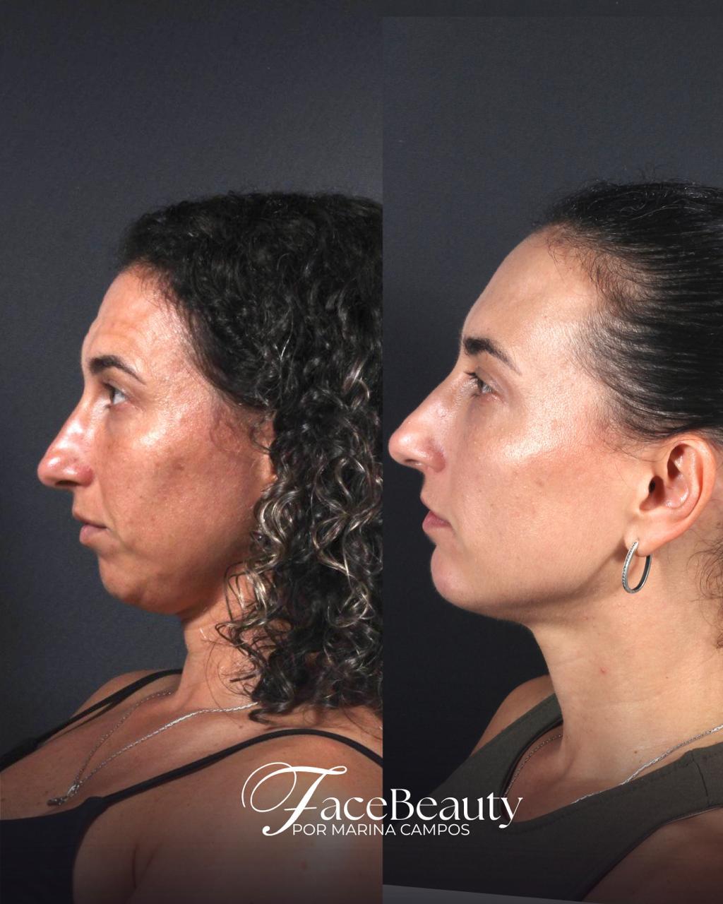 Antes e depois — Bioestimulador de colágeno