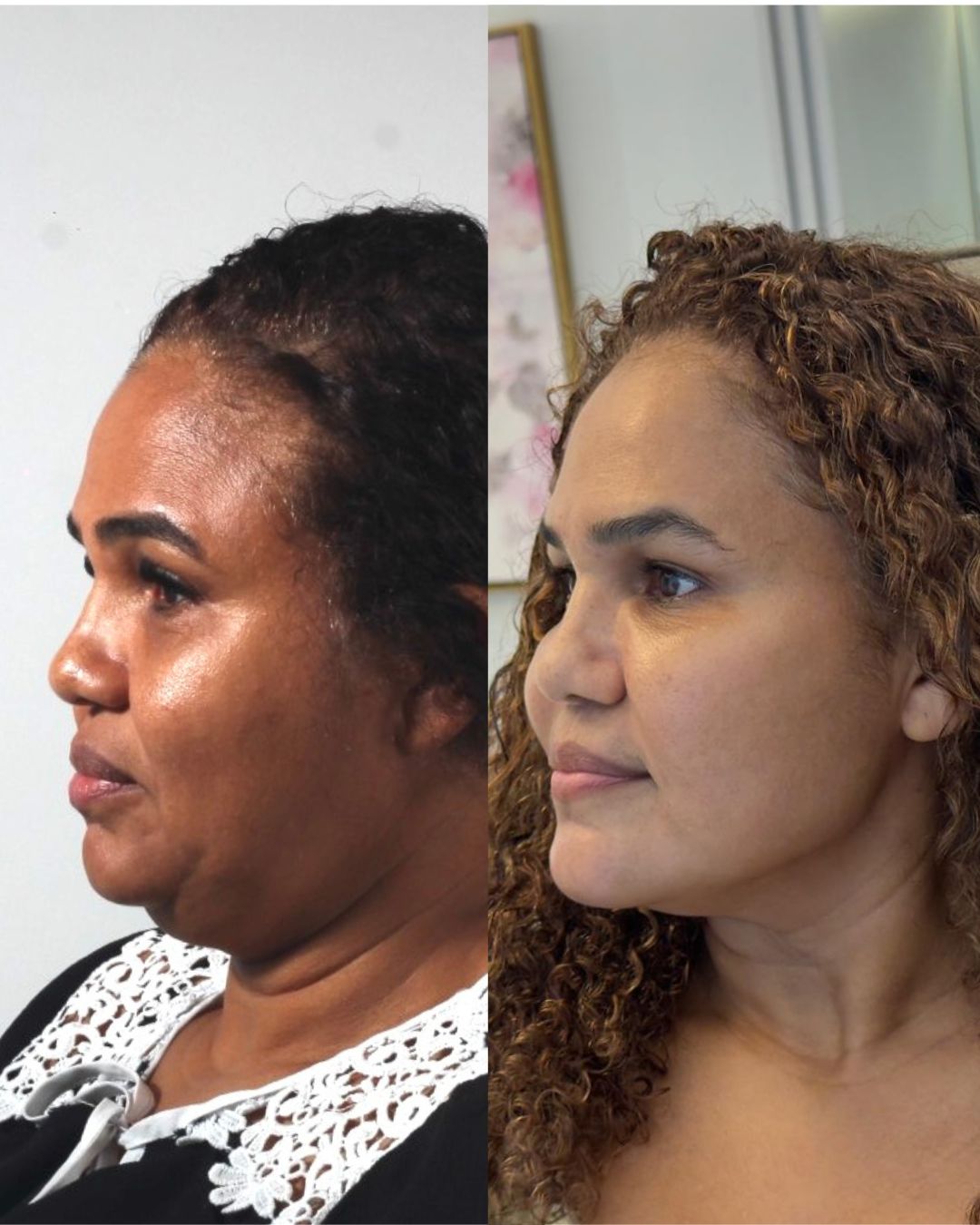 Antes e depois — Uniformização e viço da pele
