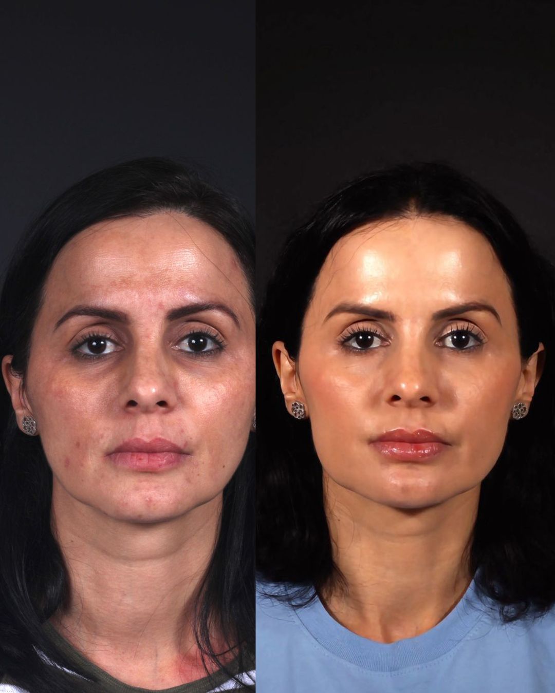 Antes e depois — Tratamento de melasma e manchas