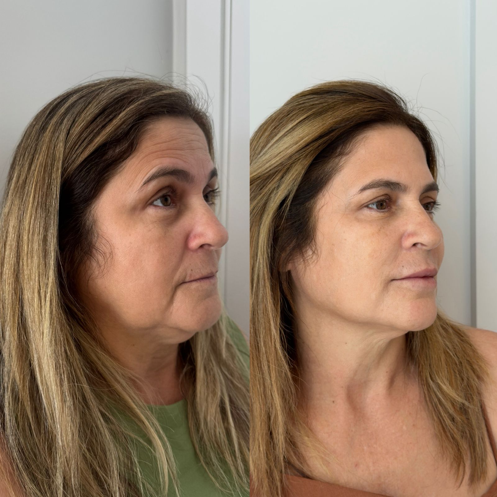 Antes e depois — Contorno e definição do terço inferior